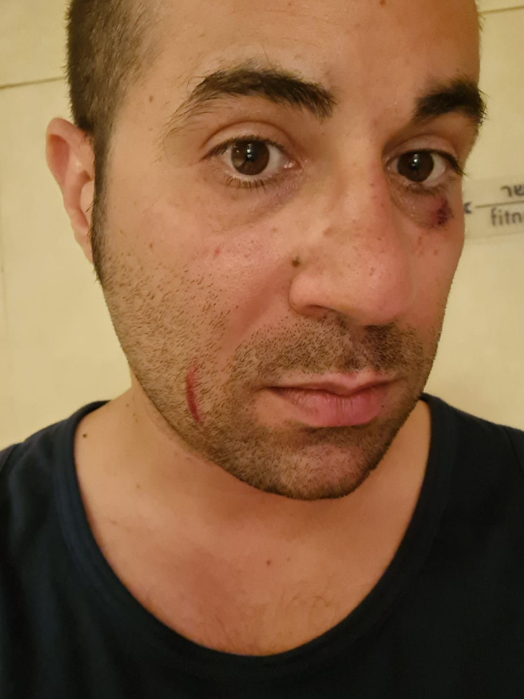 דורון לוי, הוכה במעלית ע''י צעיר (צילום: רותם לוי)