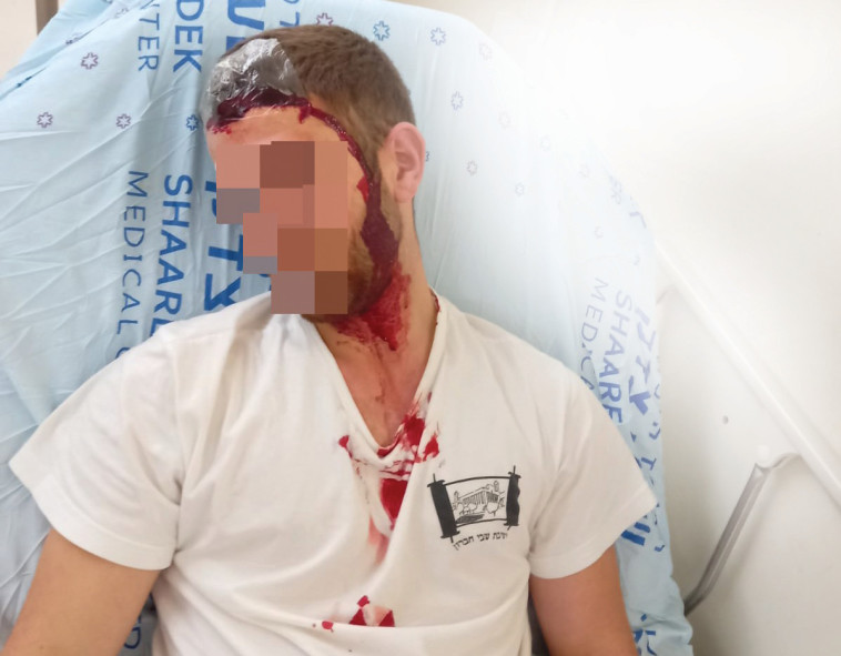 תלמיד ישיבת שבי חברון שנפצע מיידוי אבנים