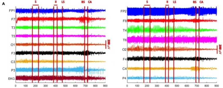 תנודות גלי מוח  (צילום: Frontiers in Ageing Neuroscience)