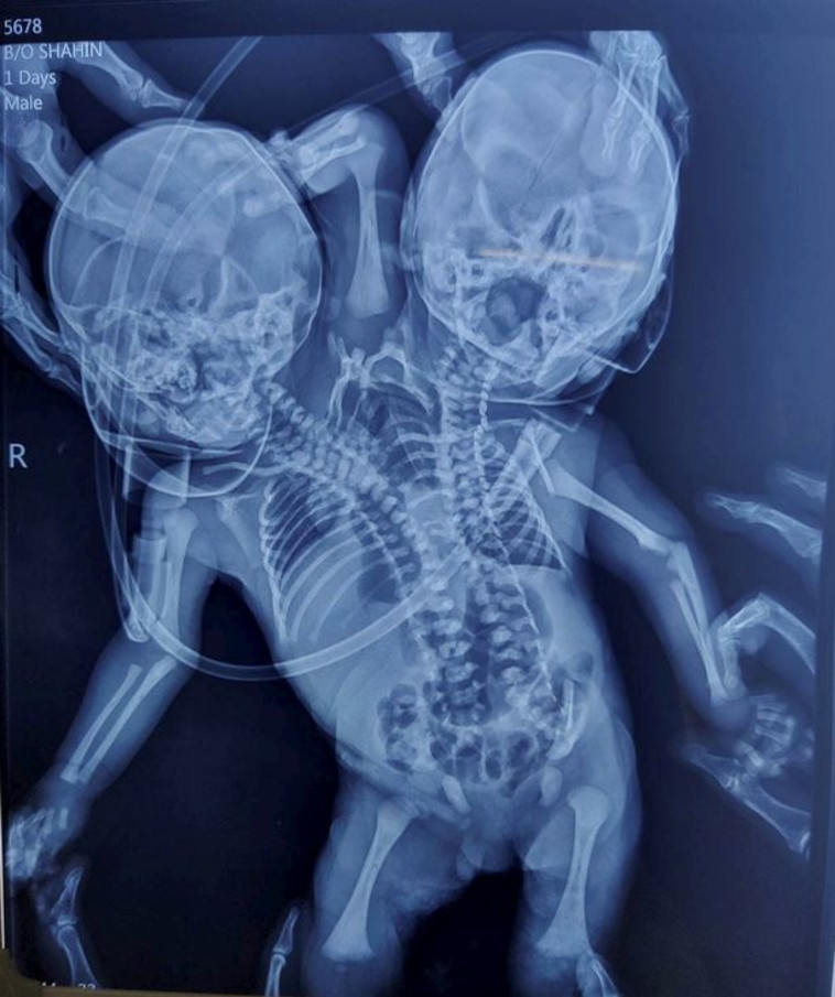 צילום רנטגן של היילוד (צילום: Ratlam hospital)