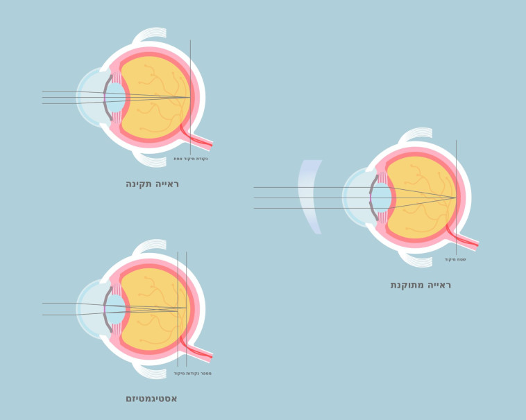בשנים האחרונות חלה התקדמות דרמטית בכל הקשור ליכולותיהם של טיפולי LASIK (צילום: FREEPIK)