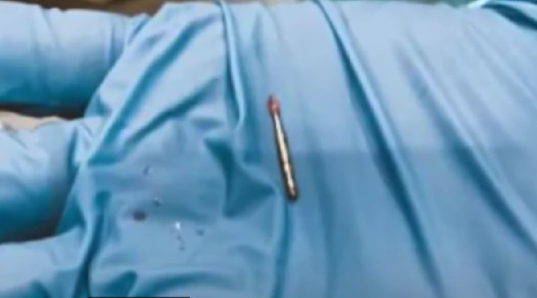 המקדח שהוצא מריאתו של ג'וזי