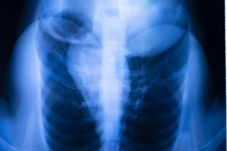 צילום ריאות, אילוסטרציה