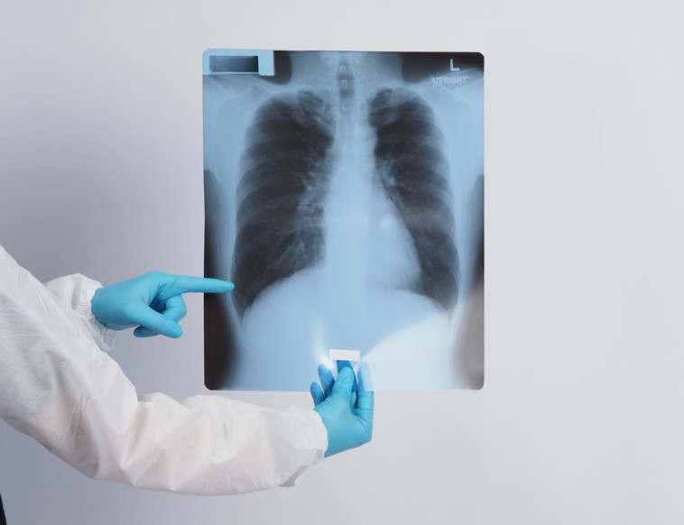 צילום ריאות, אילוסטרציה