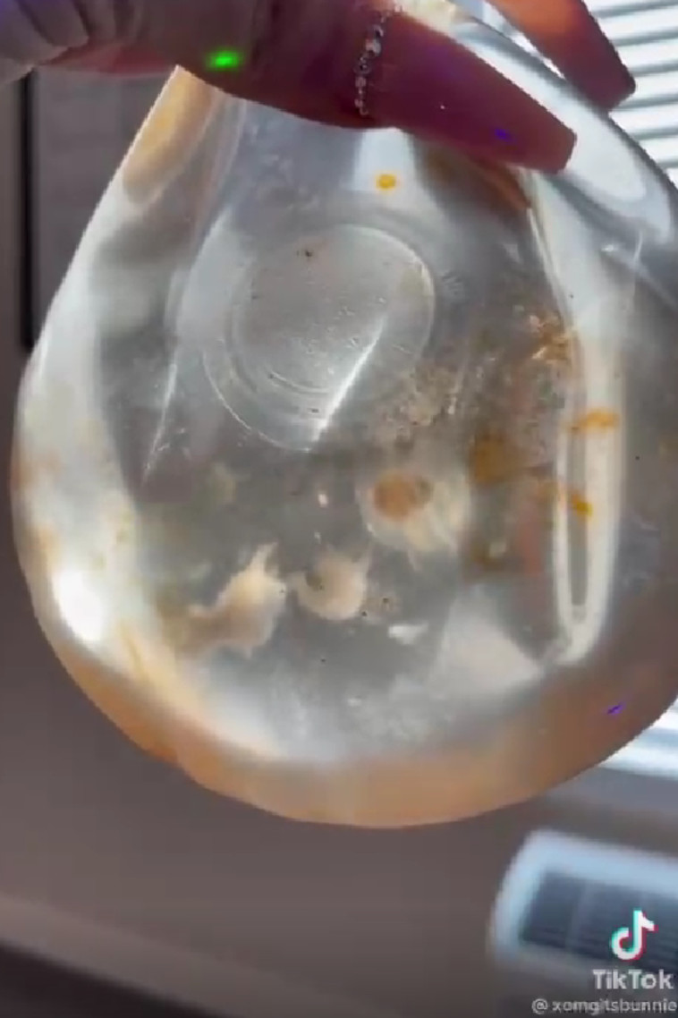 שתל הסיליקון שהוצא מהשד