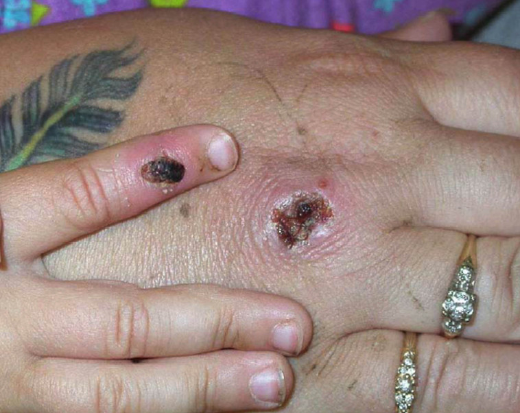 Monkey Chickenpox (Photo: CDC / Getty Images)