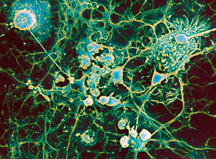 צילום במיקרוסקופ אלקטרונים סורק של תאי מיקרוגליה (עגולים) תוקפים תאי עצב (צילום: PROFESSOR JOHN ZAJICEK / SCIENCE PHOTO LIBRARY)