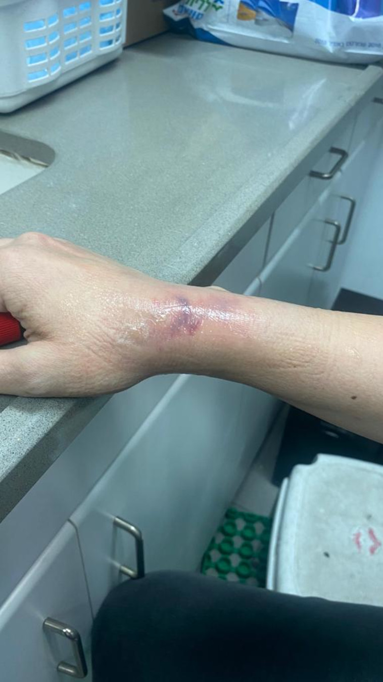 הפציעה של הרוקחת בפתח תקווה