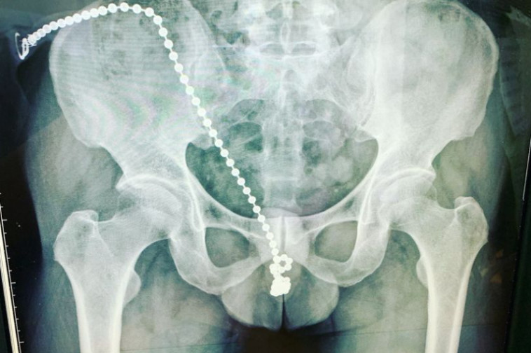 צילום הרנטגן של האיש