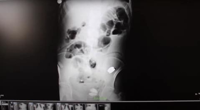 צילום הרנטגן מתוך הקיבה של המטופל (צילום: Ipakiolo hospital)