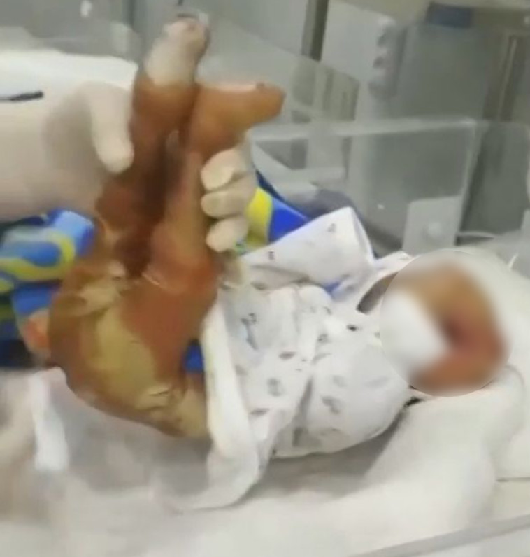 נולד עם מחלת עור חמורה ולא שרד