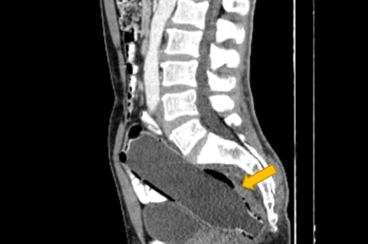 בקבוק באורך 19 ס''מ בפי הטבעת