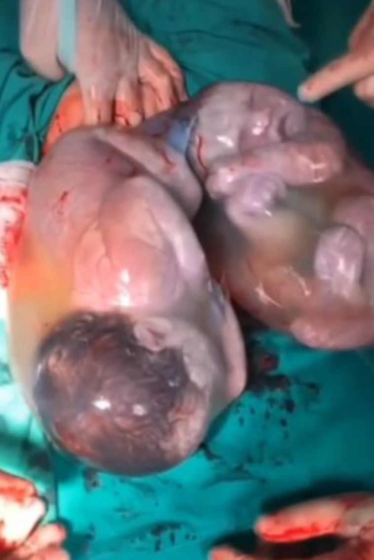 התאומות עדיין בתוך שק מי השפיר