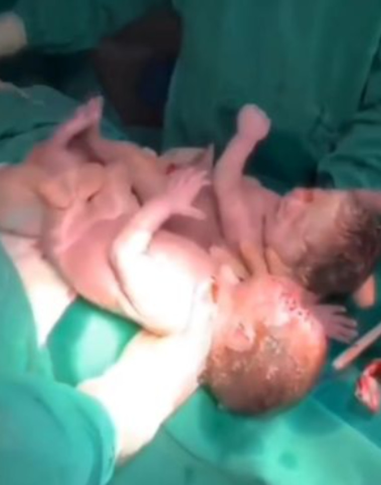 לידה מסוג זה קרויה ''לידת בתולת ים'', או לידה ''מצועפת''