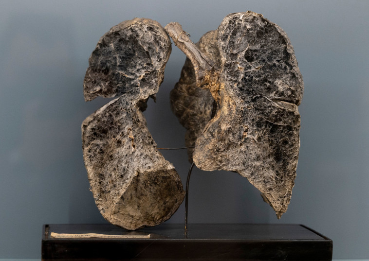 ריאות של אדם שעישן (צילום: Getty images)