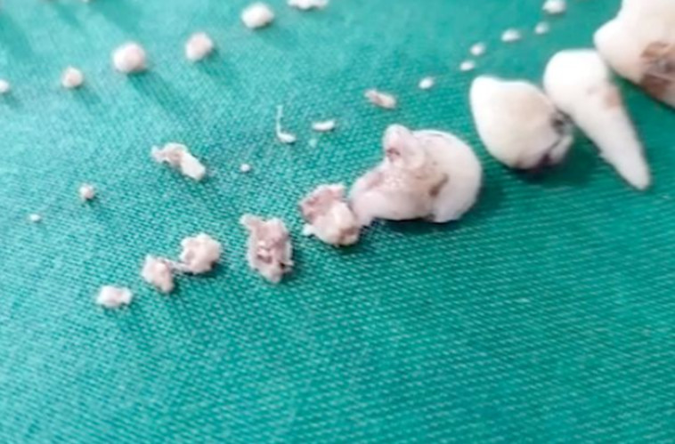 526 שיניים בגדלים שונים הוצאו מפיו של בן השבע