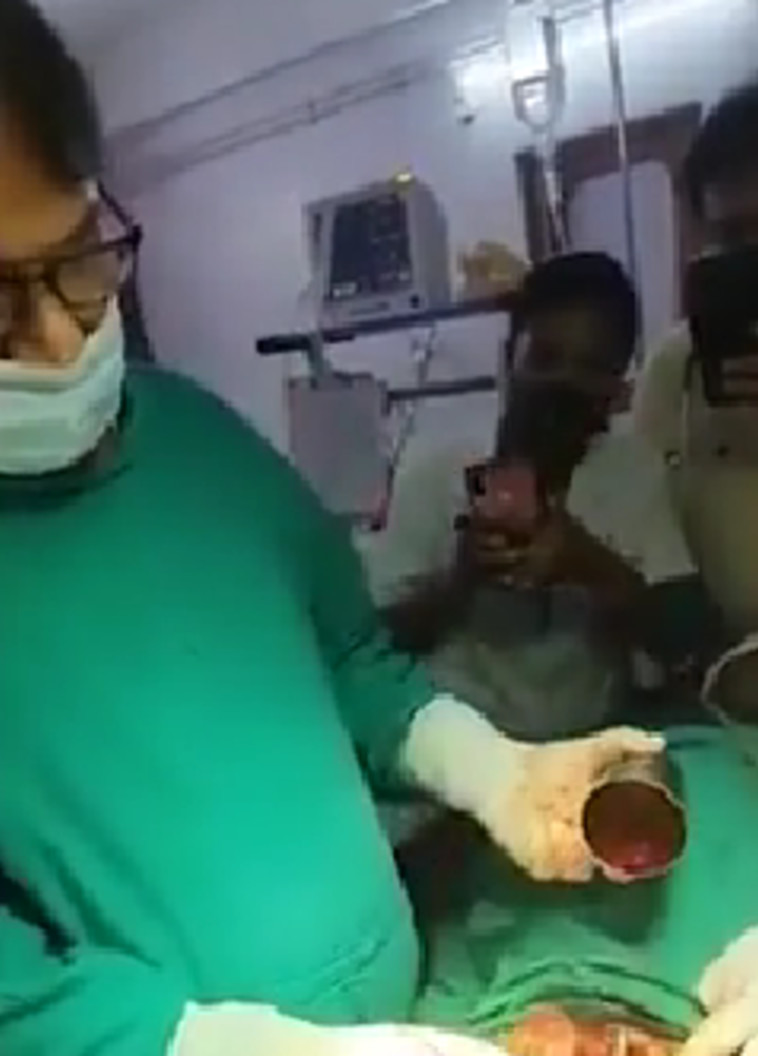  ד''ר לאל בהדור, אוחז בכוס המתכת לאחר שהוצאה מבטנו של המטופל (צילום: מתוך פייסבוק)