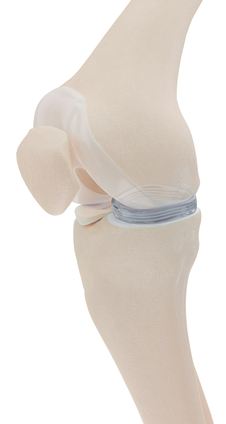 שתל המניסקוס המלאכותי ה-&reg;NUsurface של אקטיב אימפלנטס- אפקטיבי יותר