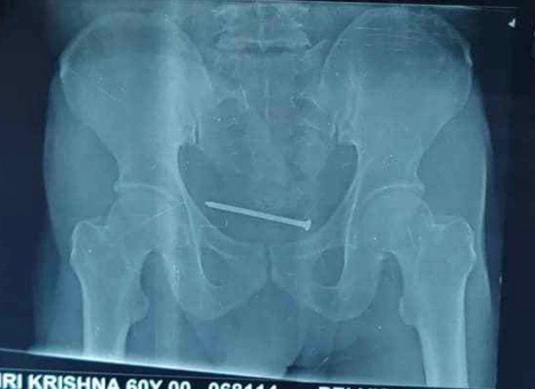 צילום הרנטגן שקלט את הממצע החריג בגופו של האיש (צילום: מתוך פייסבוק)