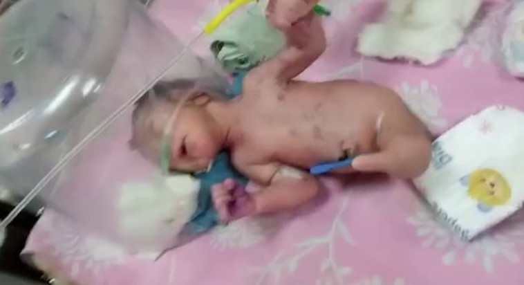 מטופל במחלקה לטיפול ביילודים מיוחדים (SNCU) של בית החולים