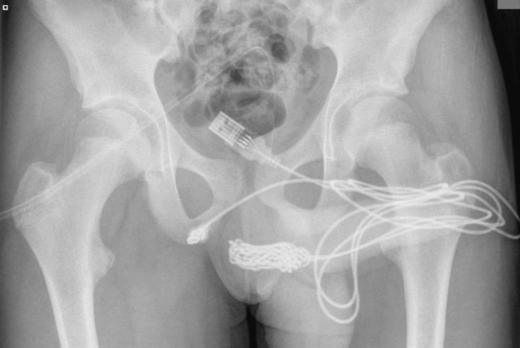 אין לנו מושג איך הוא עשה את זה. צעיר החדיר כבל USB לצינורית השופכה