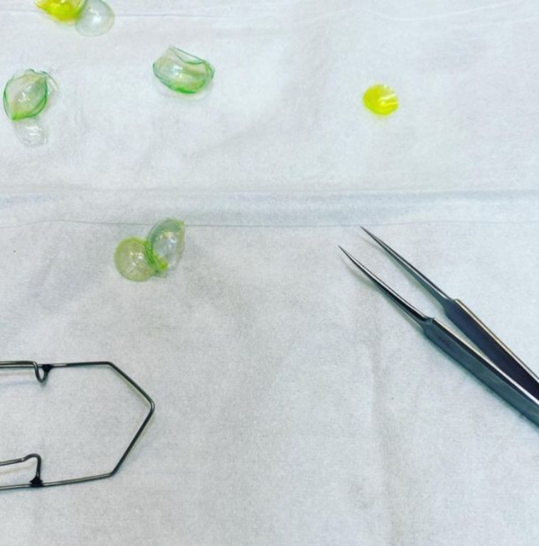 עדשות המגע הראשונות שהוצאו מעיניה של המטופלת