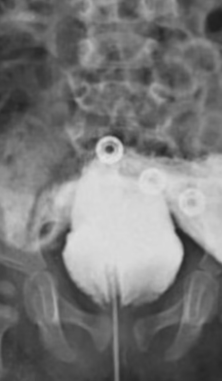 גילו פיסטולה, חיבור לא תקין בין שלפוחית השתן שלו לפי הטבעת