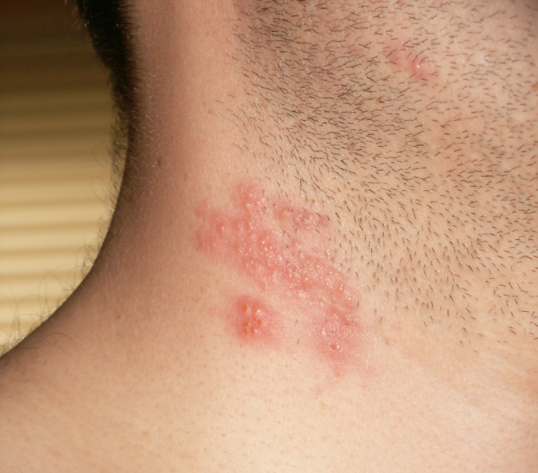 שלבקת חוגרת בצוואר (צילום: ויקיפדיה,CC BY-SA 3.0)