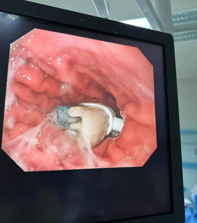 המברשת כמעט חסמה את מעיו של בן התשע