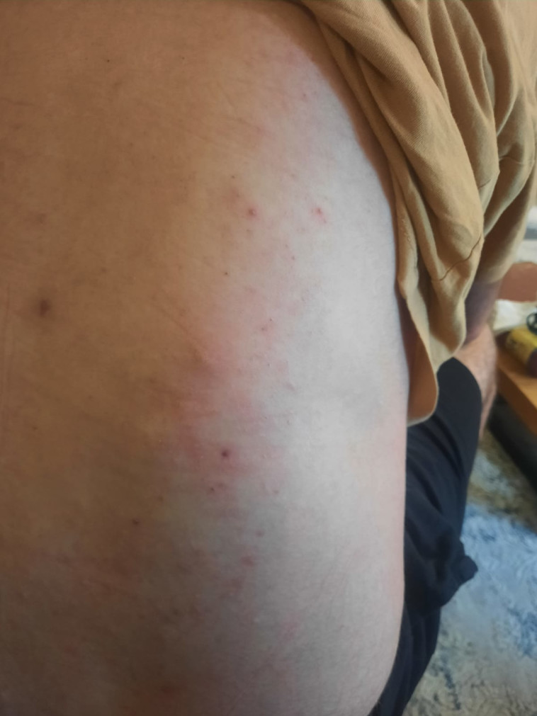 גבו של ליאם יריב, שהותקף באוטובוס בפתח תקווה