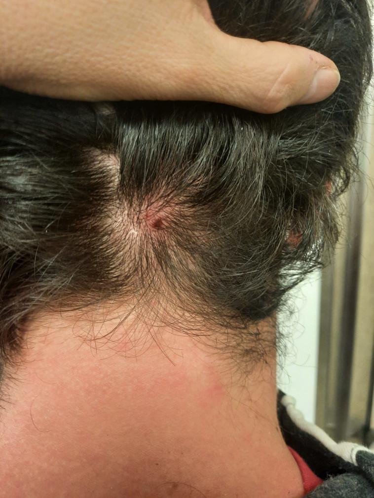 ראשו של ליאם יריב, שהותקף באוטובוס בפתח תקווה