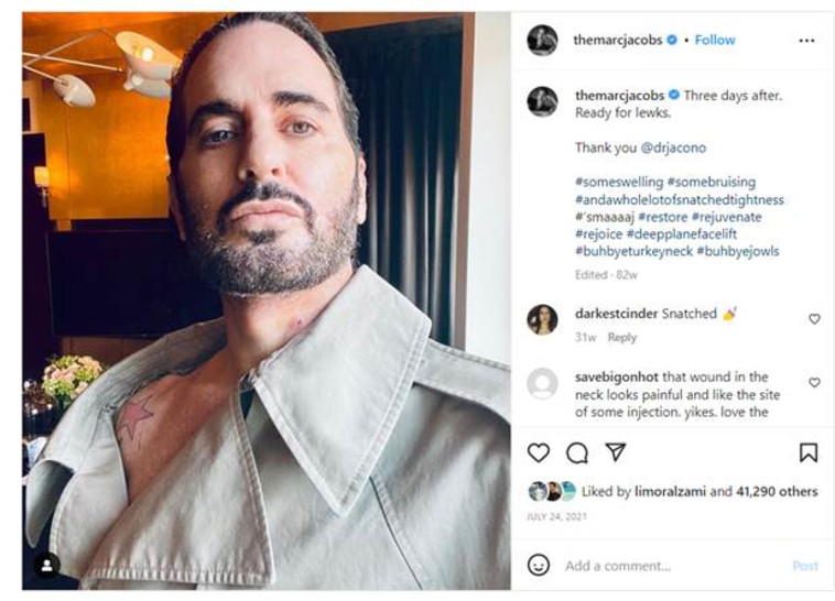 מארק גייקובס אחרי מתיחת פנים