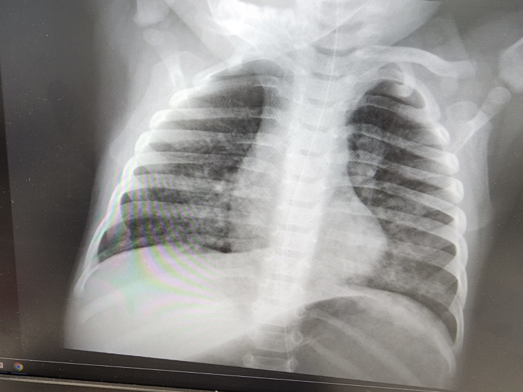 צילום ריאות של התינוקת (צילום: בית החולים אסותא אשדוד)