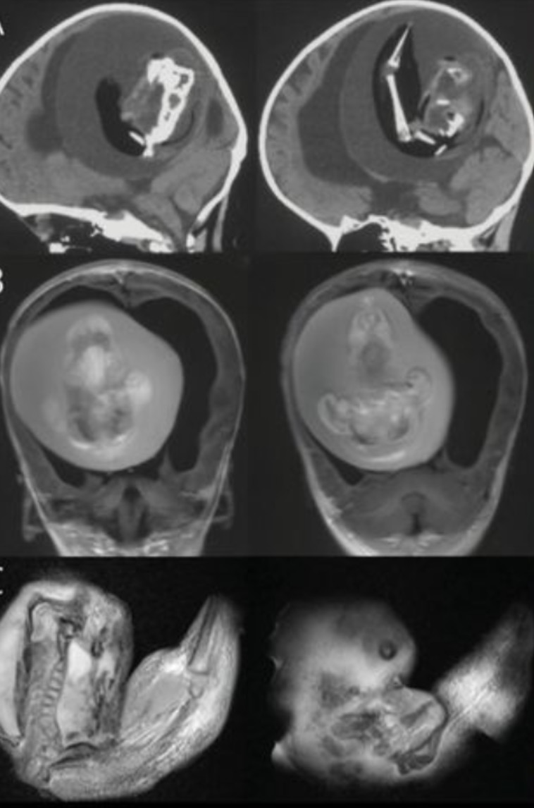התאום המשיך לגדול בראשה אחרי שנולדה