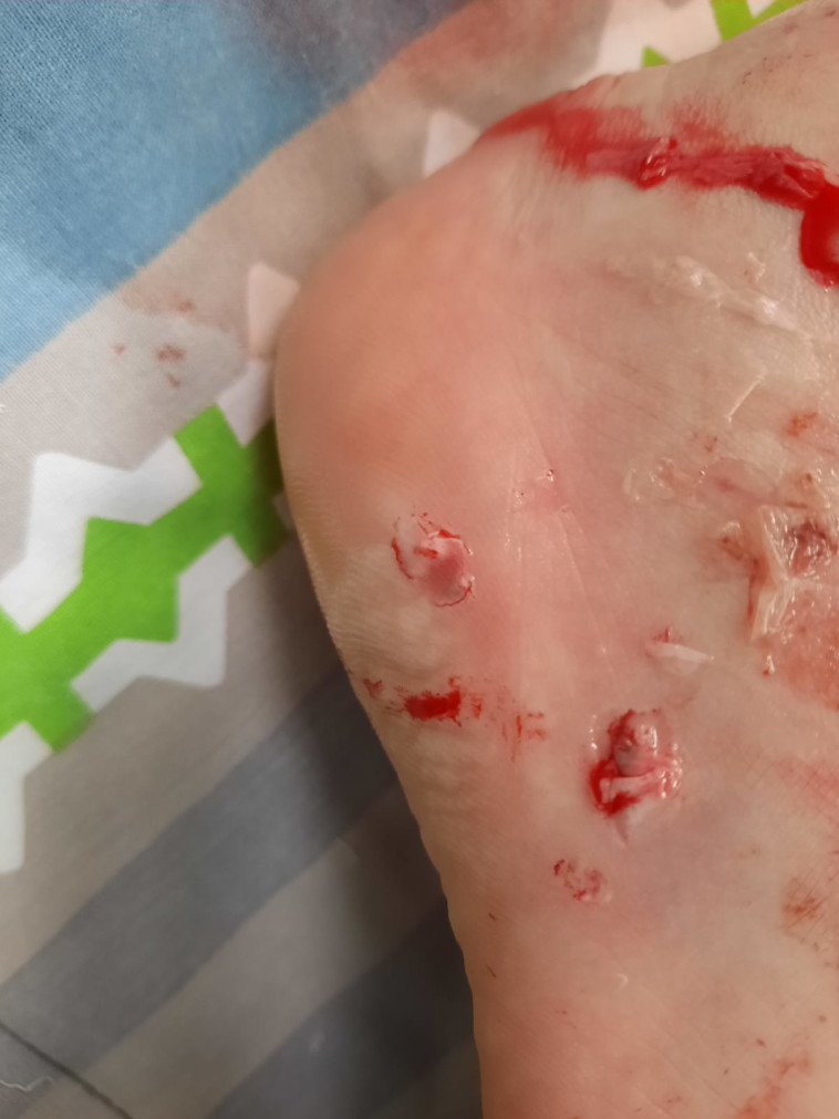 הפציעות שנגרמו לנערה