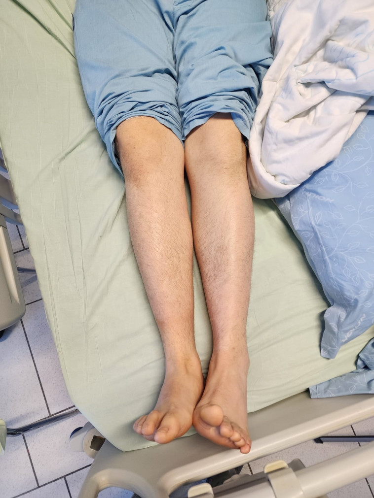 רגליו של אפרים כהן לאחר הניתוח שעבר בהצלחה (צילום: בית החולים אסותא אשדוד)