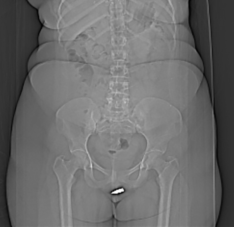 תוצאות בדיקת ה-CT הציגו את הקליע