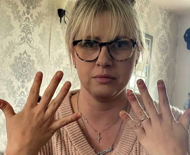 דיואי בת ה-36, נמצאה אלרגית לכימיקל בלק ג'ל