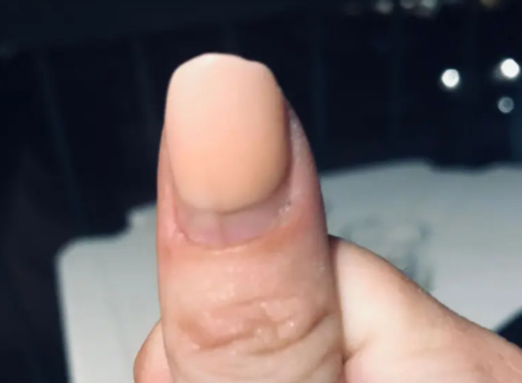 המניקוריסטית חשפה ממצא חריג מתחת לציפורן והפנתה את הלקוחה לרופא עור