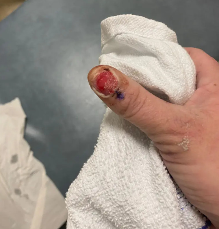 הציפורן הוסרה ונשלחה לביופסיה