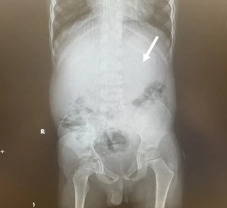 40 מסטיקים חסמו את מערכת העיכול של הקטין