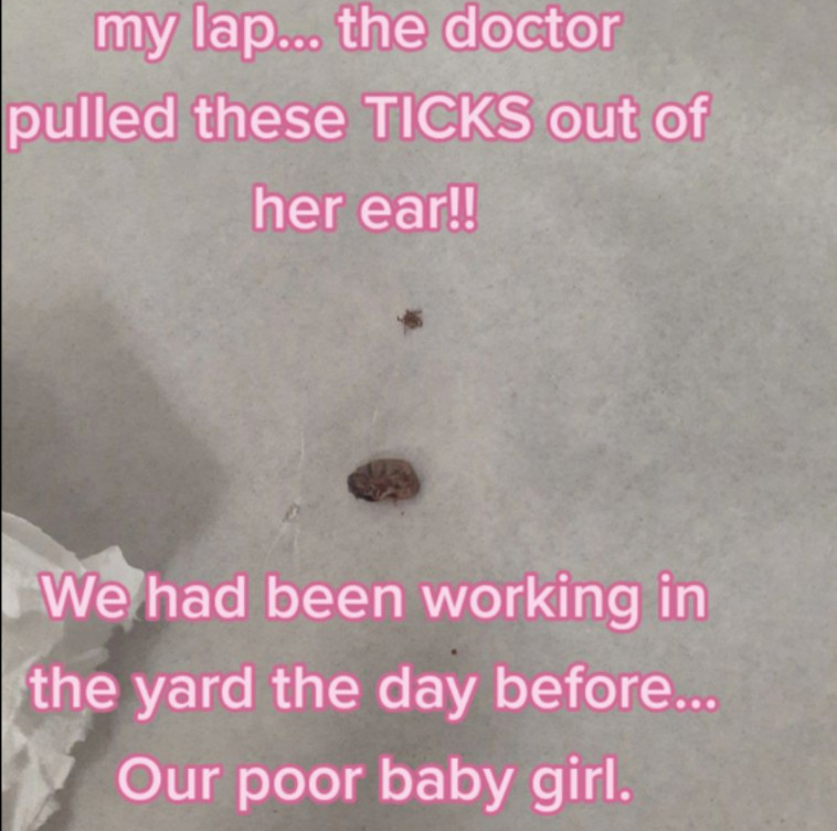 קרציות בשני גדלים שונים הוצאו מאוזנה של בת השנתיים