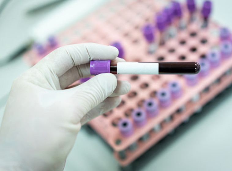 ''מדובר בבדיקת דם רגילה וללא סיבוכים, זאת בניגוד לביופסיה''.