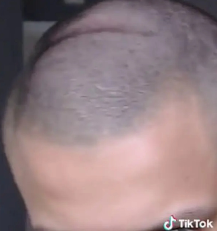 נוצר שקע בגולגולת כתוצאה משימוש ממושך באוזניות