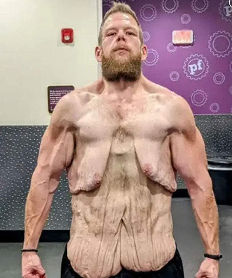 נזקק לחמישה ניתוחים לפחות כדי להיפטר מהעור הרפוי