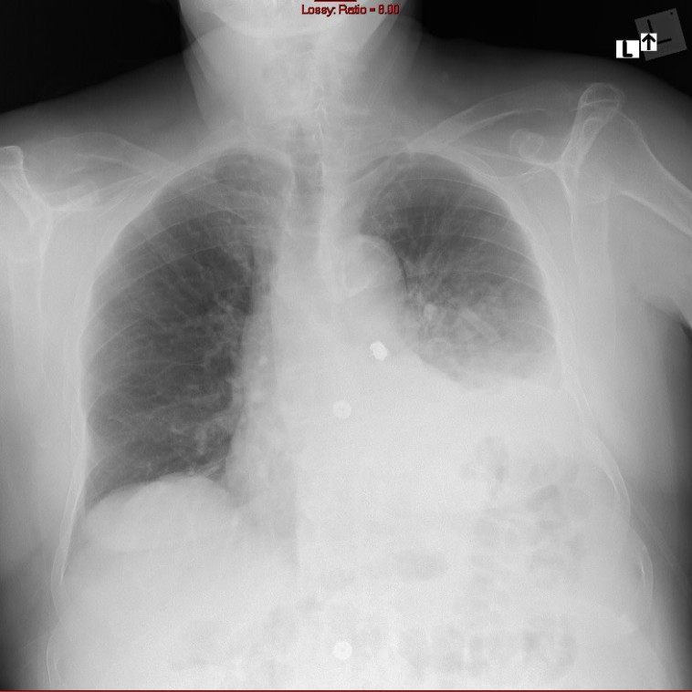 צילום החזה בו נראית השן בתוך הריאות של מ' (צילום: דוברות מרכז רפואי ''מאיר'' מקבוצת ''כללית'')