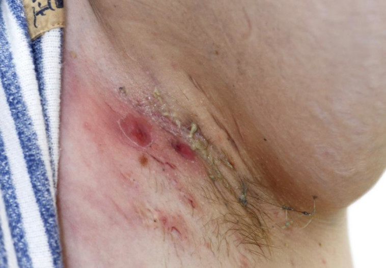 בית שחי של חולה במחלת העור הידרדניטיס ספורטיבה